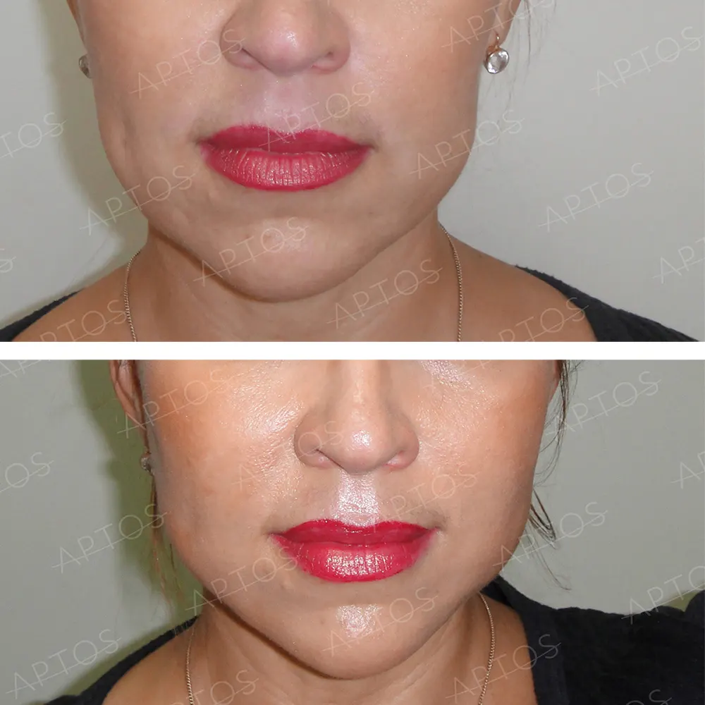 aptos-auri-przedipo-6